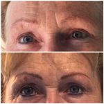 Permanente make-up 3D hairstrokes en hairstrokes uden